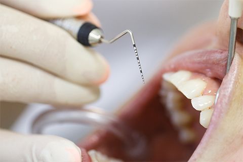 Periodoncia en la Sagrera en Blaudent Periodoncia en la Sagrera en Blaudent