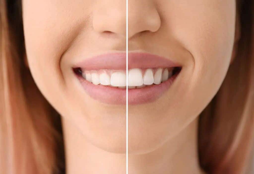 Gingivectomía y osteoplastia Gingivectomía y osteoplastia