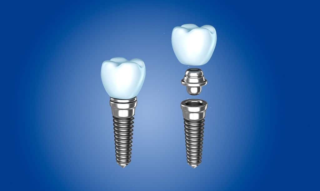 Los mejores implantes dentales en La Sagrera Barcelona