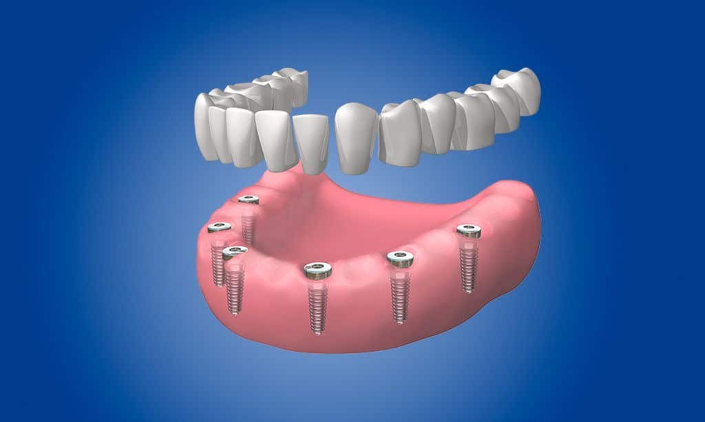 Dentaduras completas fijas en La Sagrera Barcelona