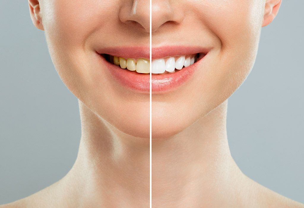blanqueamiento dental en la sagrera barcelona blanqueamiento dental en la sagrera barcelona