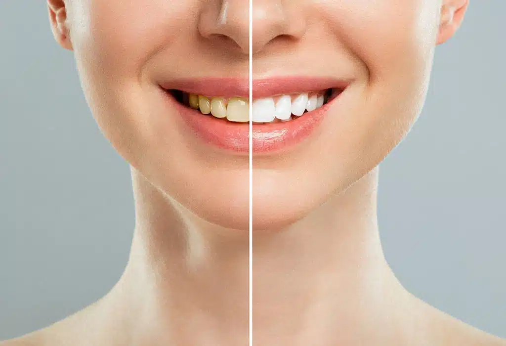 blanqueamiento dental en la sagrera barcelona