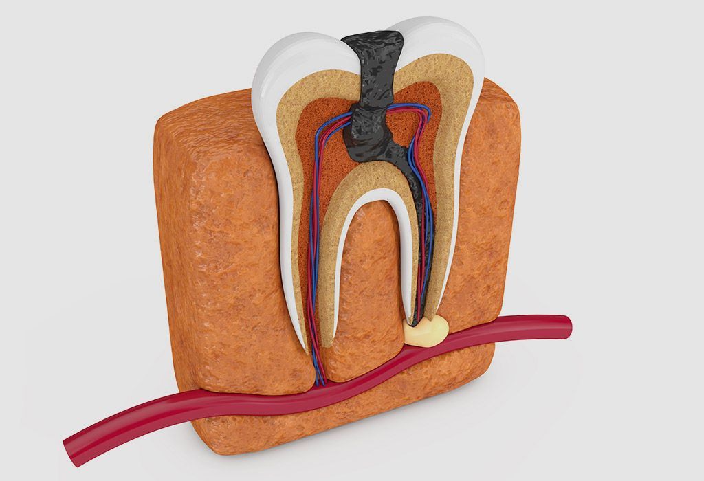 Endodoncia en La Sagrera: caries profundas Endodoncia en La Sagrera: caries profundas