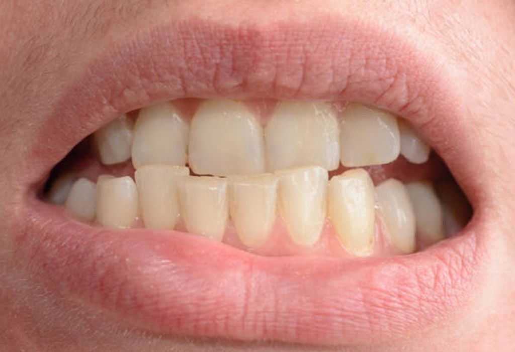 Endodoncia en La Sagrera: Desgaste dental excesivo Endodoncia en La Sagrera: Desgaste dental excesivo