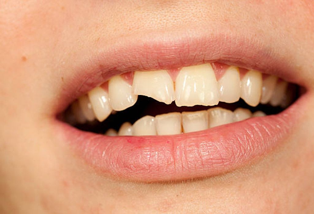 Endodoncia en La Sagrera: Fracturas o traumas dentales Endodoncia en La Sagrera: Fracturas o traumas dentales