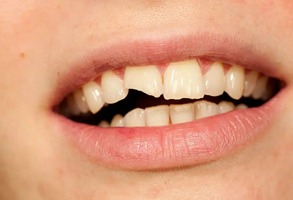 Endodoncia en La Sagrera: Fracturas o traumas dentales Endodoncia en La Sagrera: Fracturas o traumas dentales