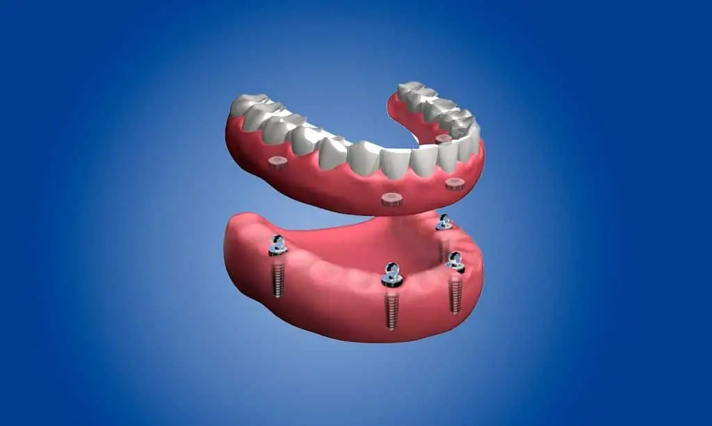 Dentaduras completas extraíbles en La Sagrera Barcelona