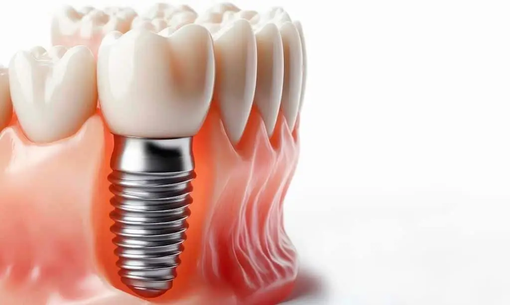Implantes dentales el la Sagrera en Barcelona Blaudent
