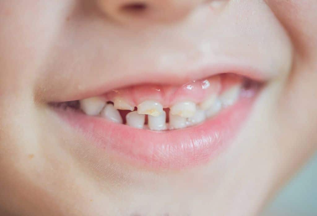 Extracciones de dientes de leche en Clinica Dental Blaudent Extracciones de dientes de leche en Clinica Dental Blaudent
