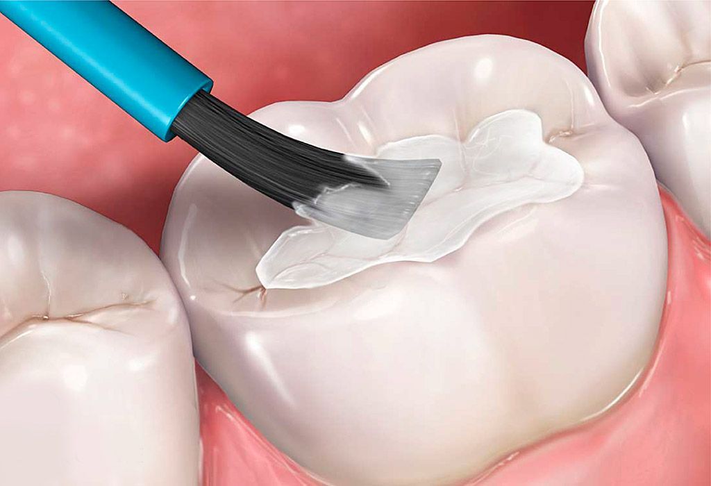 odontopediatria: Sellado de fisuras odontopediatria: Sellado de fisuras