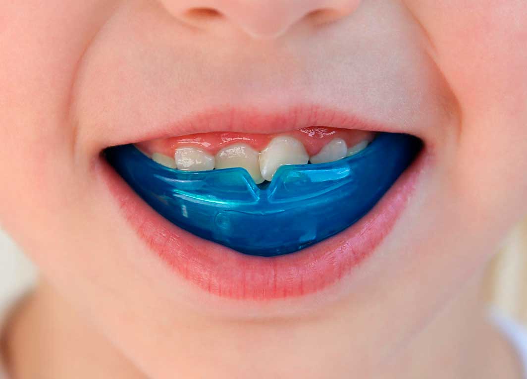 Ortodoncia sin brackets para Kids