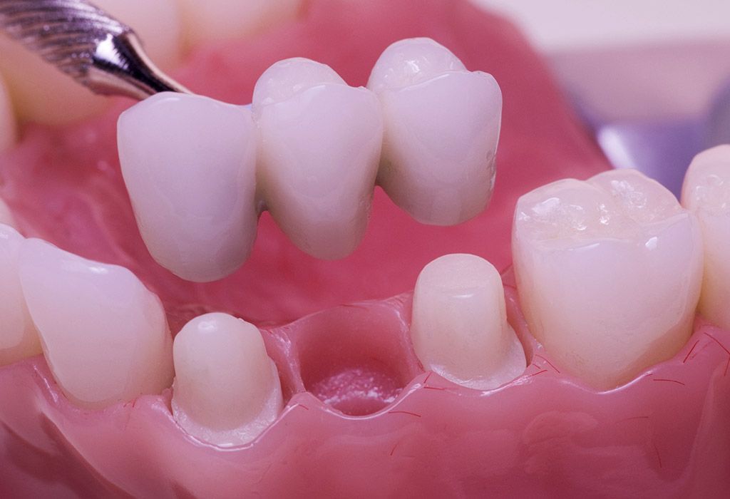 Prótesis dental fija en La Sagrera